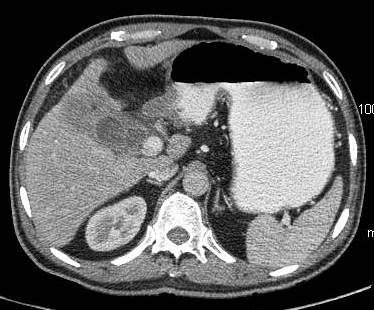 Figure 7: infiltrative carcinoma with necrotic lymph node medially and gross invasion of liver parenchyma in the region of fundus.
